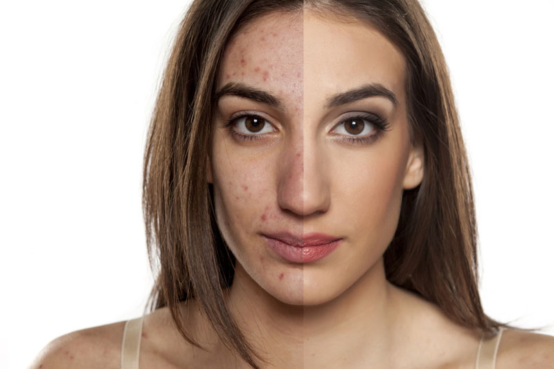Melhores produtos para pele com acne