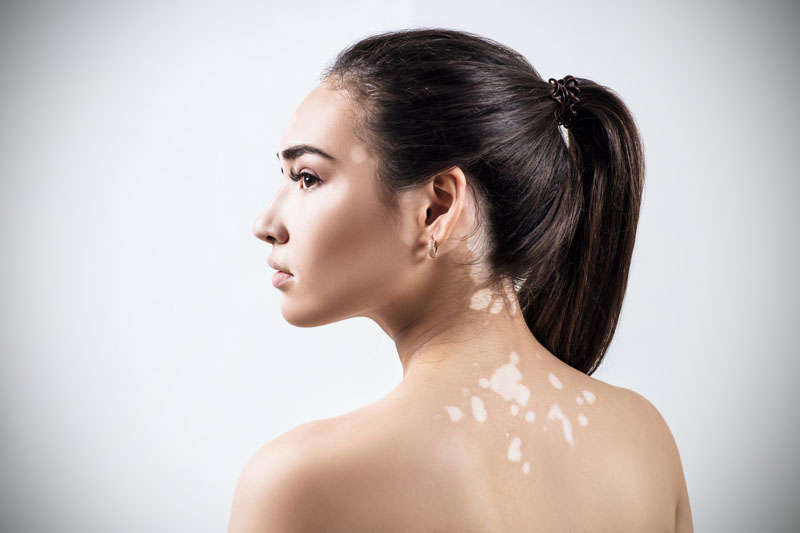 Melhores produtos para pele com vitiligo